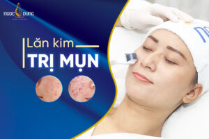 Lăn kim trị mụn có tốt không?