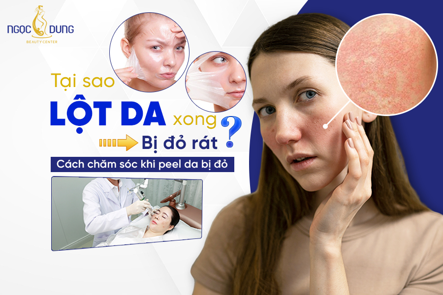 lột da xong bị đỏ rát