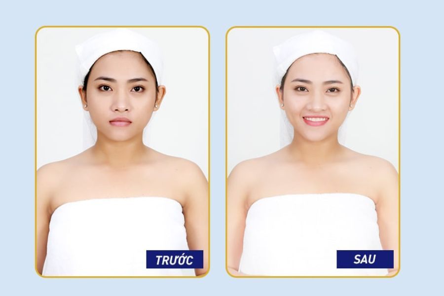 Hình ảnh khách hàng trước và sau khi tẩy tế bào chết, chăm sóc da chuyên sâu tại Ngọc Dung beauty