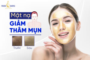 Mặt nạ giảm thâm mụn