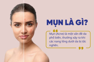 Mụn xuất hiện do các nang lông dưới da bị tắc nghẽn