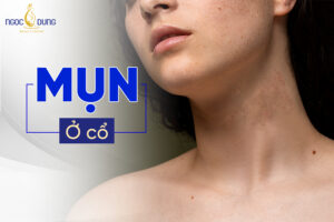 Nguyên nhân, cách điều trị và ngăn ngừa mụn ở cổ