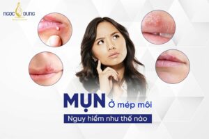 Nổi mụn ở vành môi nguy hiểm như thế nào? Cùng chuyên gia giải đáp ngay