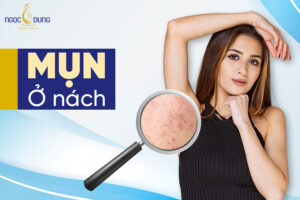 Bị nổi mụn ở nách phải làm sao? Các ngăn ngừa mụn nách