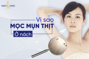 Vì sao mọc mụn thịt ở nách? 5 cách trị mụn dư nách hiệu quả