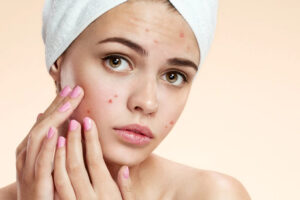 Các loại mụn thường gặp ở tuổi dậy thì