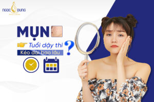 Mụn tuổi dậy thì kéo dài bao lâu? 