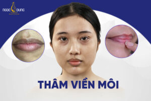 Nguyên nhân và 7 cách trị thâm viền môi nhanh, ít tốn công