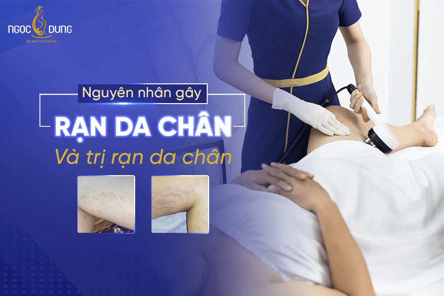 Những cách trị rạn da chân hiệu quả nhất