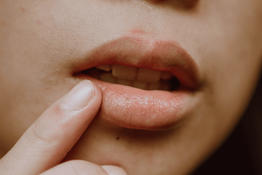 Những dấu hiệu nhận biết viền môi thâm 