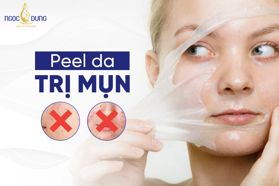 Peel da trị mụn có tốt không? Có nên tự peel da tại nhà?