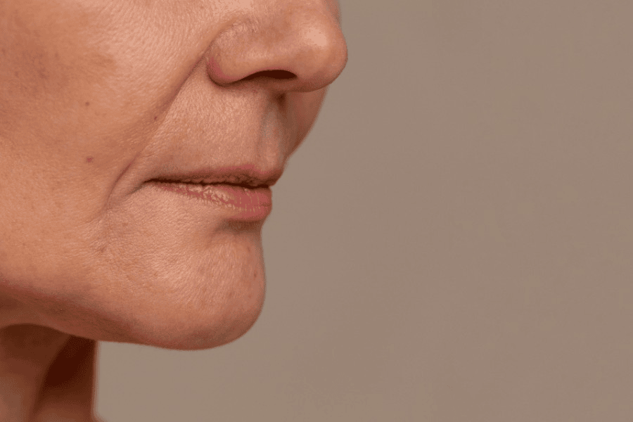 Phân loại các nếp nhăn tại vùng miệng 