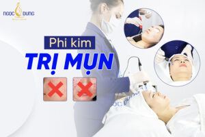 Phi kim trị mụn là gì? Có tốt không? Chi phí bao nhiêu?