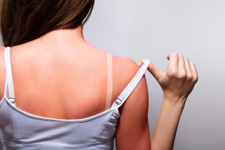 Bị cháy nắng là một trong các nguyên nhân khiến da hư tổn nhanh chóng