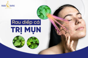 Có nên dùng rau diếp cá để trị mụn không?