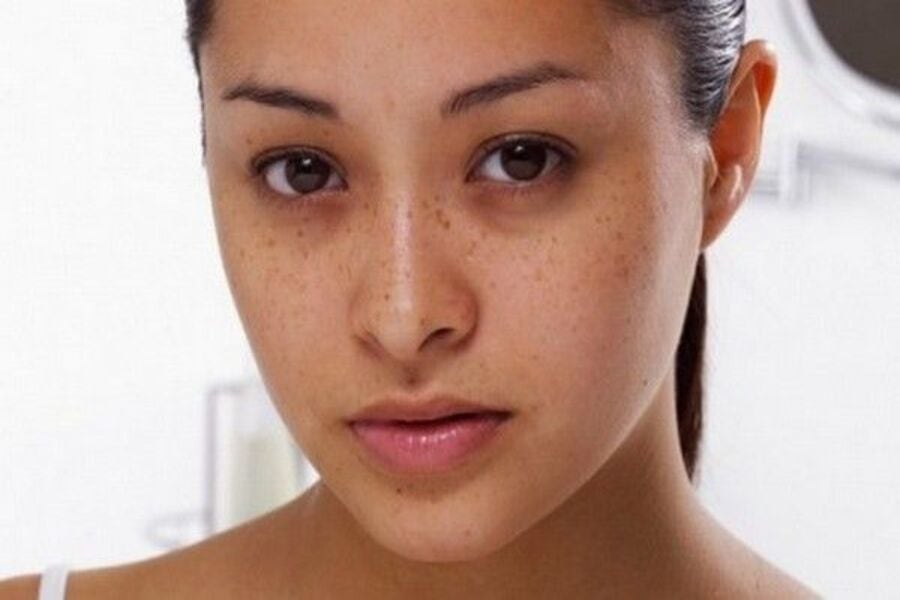 Bị sạm da không gây ảnh hưởng trực tiếp đến sức khỏe nhưng lại tác động đáng kể đến diện mạo của bạn