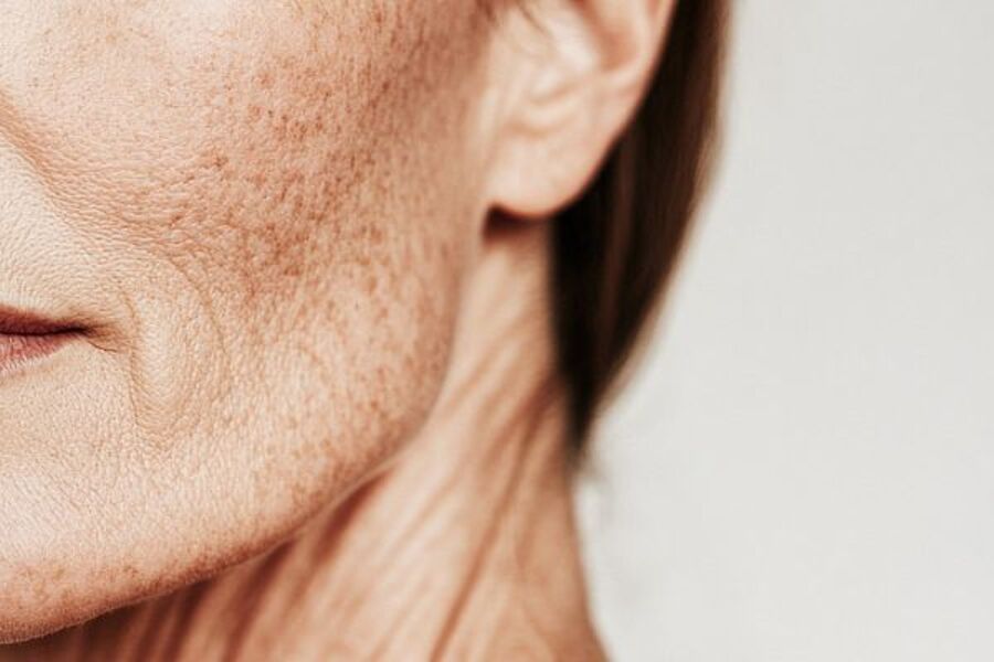 Lão hóa cũng là nguyên nhân làm da bị sạm