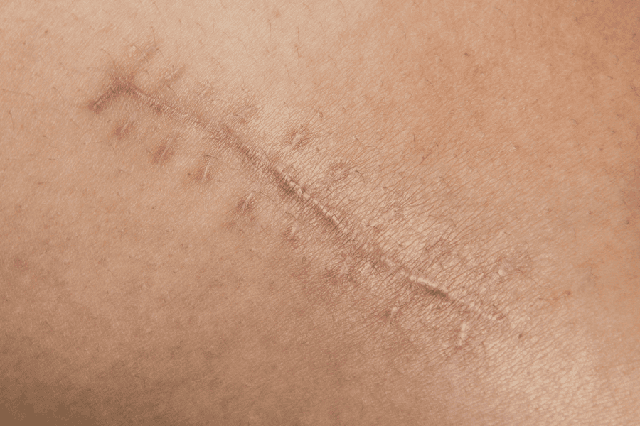 Phân biệt các loại sẹo: Cách nhận biết và điều trị đúng 5 Sẹo co rút hình thành sau vết bỏng hoặc chấn thương lớn