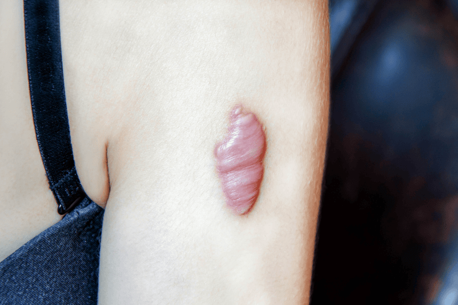 Sẹo lồi gây mất thẩm mỹ vì bề mặt gồ ghề và dày