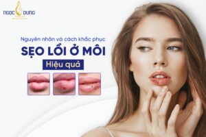 sẹo lồi ở môi