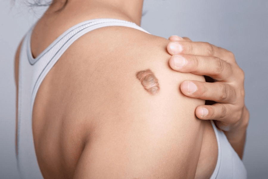 Phân biệt các loại sẹo: Cách nhận biết và điều trị đúng 3 Sẹo lồi và sẹo phì đại ảnh hưởng rất lớn tới thẩm mỹ