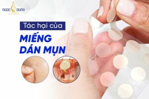 Điểm qua những tác hại của miếng dán mụn để chị em cân nhắc khi sử dụng