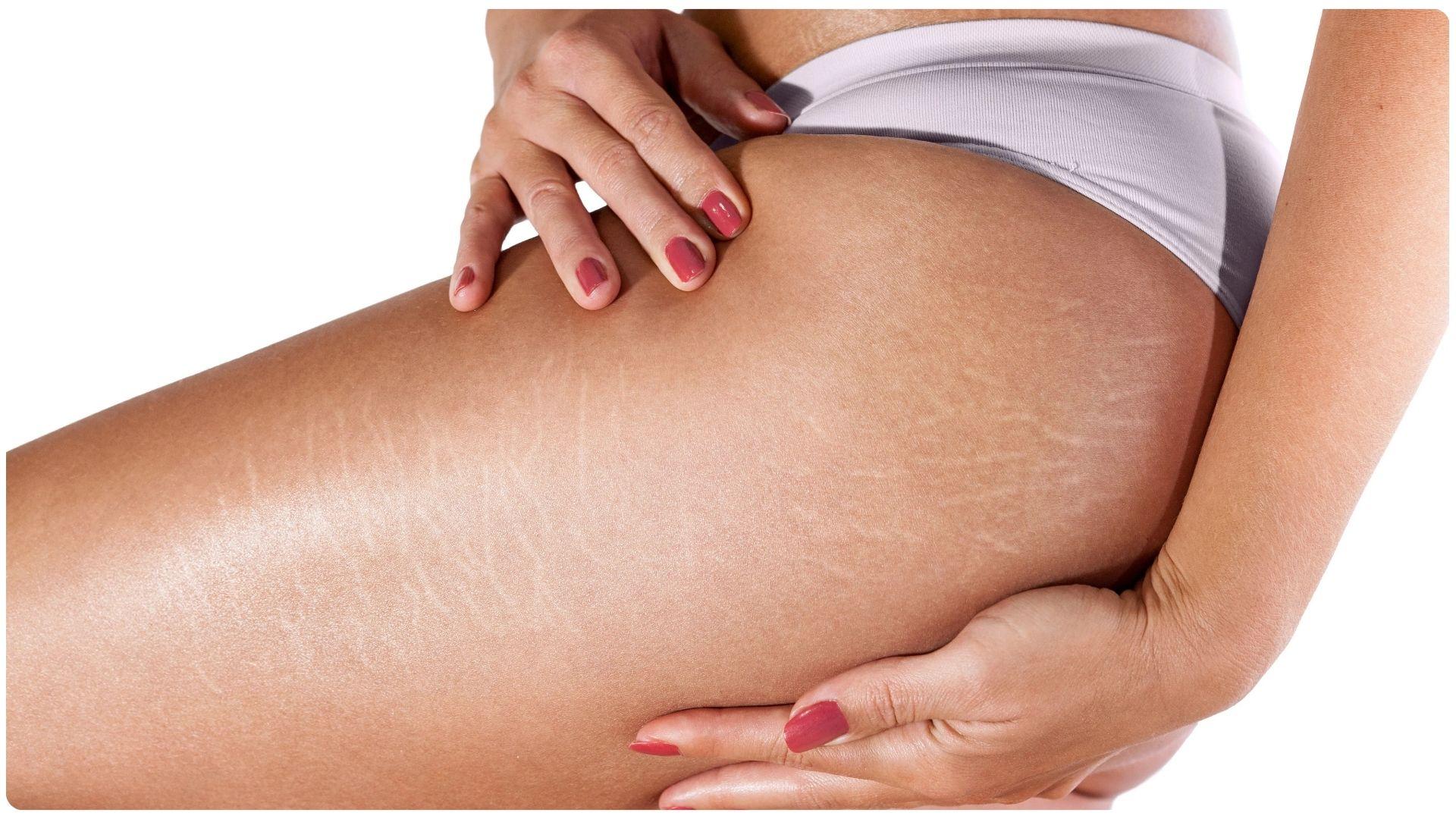 Tăng cân nhanh là nguyên nhân chính khiến đùi xuất hiện các vết rạn