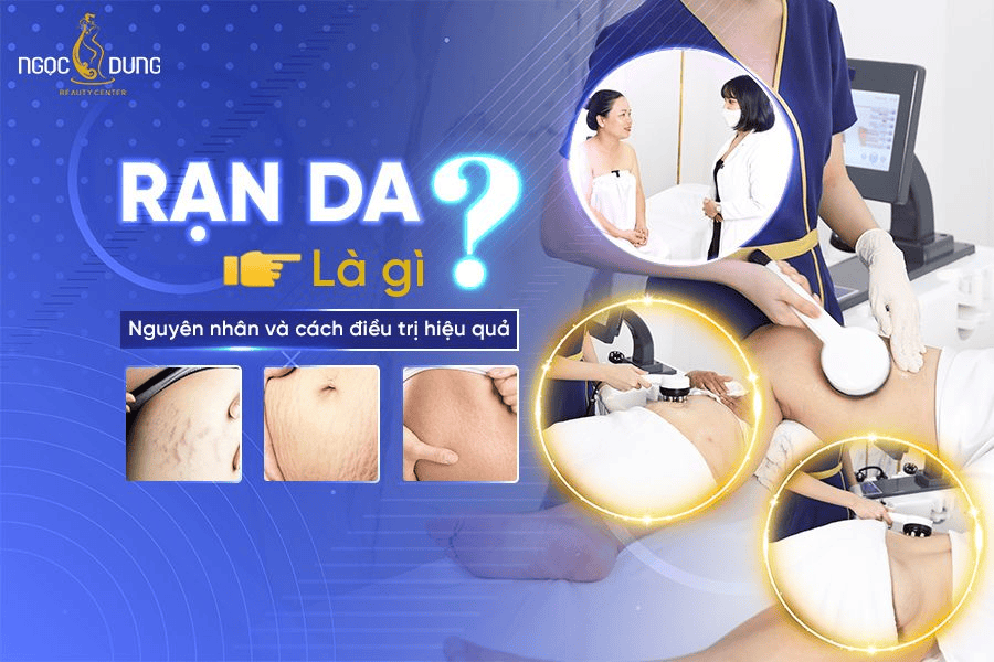 Tổng hợp các phương pháp trị rạn da hiệu quả