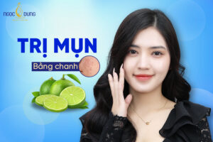 Có nên trị mụn bằng chanh hay không?
