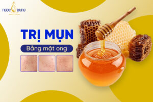 Hướng dẫn 9 cách trị mụn bằng mật ong hiệu quả ngay tại nhà