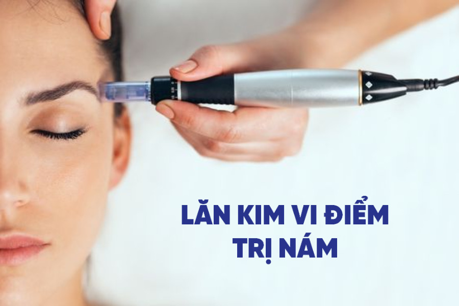 Lăn kim là một trong những phương pháp điều trị nám được yêu thích nhất hiện nay