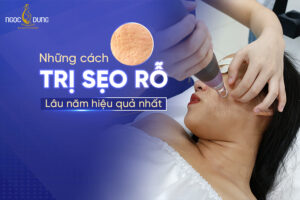 trị sẹo rỗ lâu năm