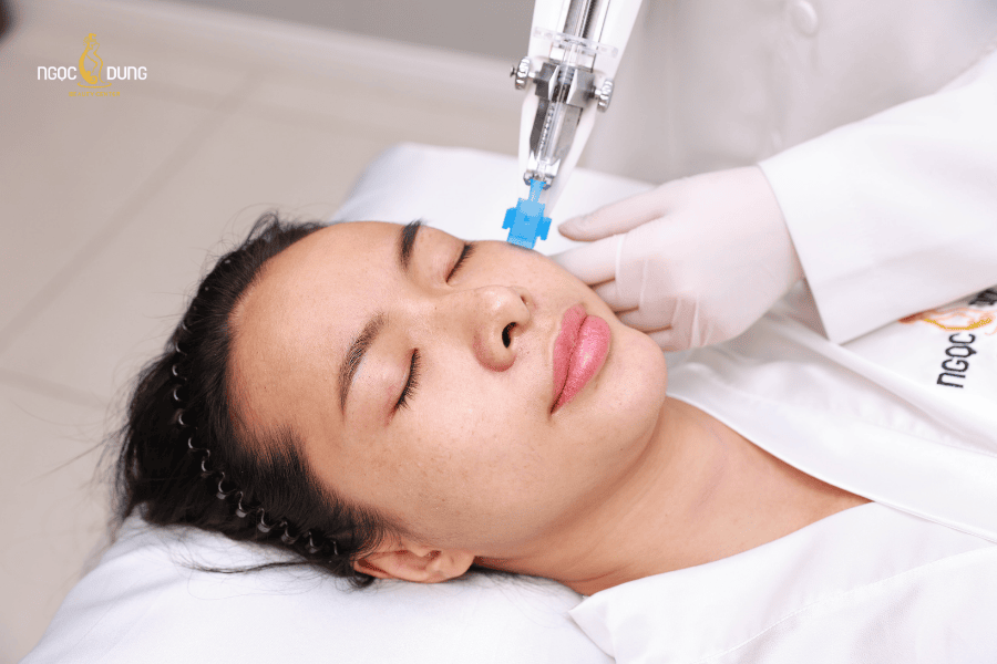 Trị thâm mụn dứt điểm bằng phương pháp laser tại Ngọc Dung