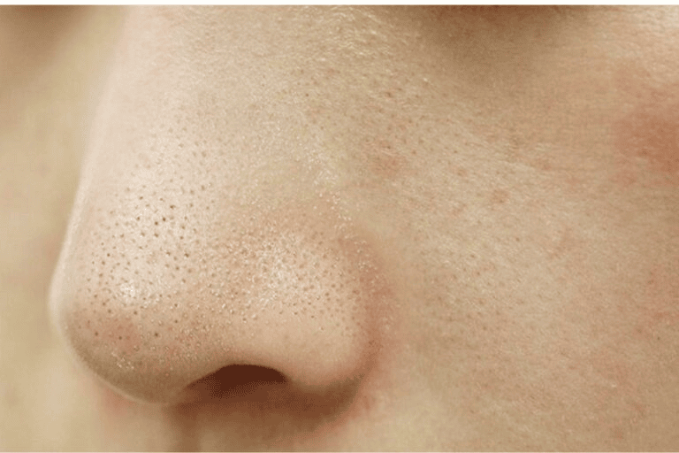 Tuyến dầu hoặt đông mạnh khiến sợi bã nhờn hình thành nhanh hơn