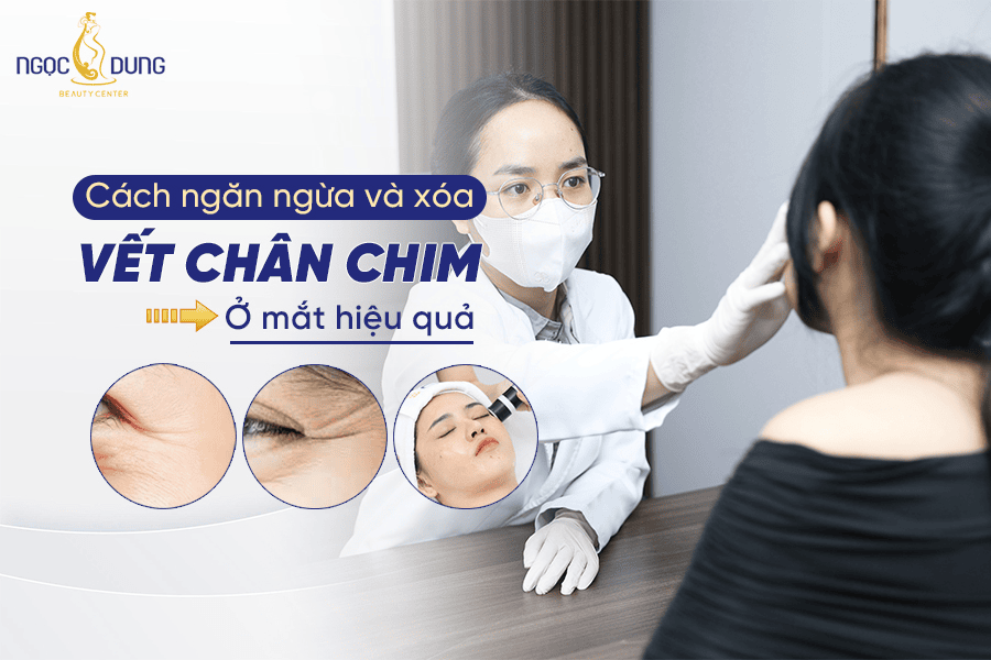 Vết chân chim ở mắt là gì? Có thể điều trị dứt điểm không? 
