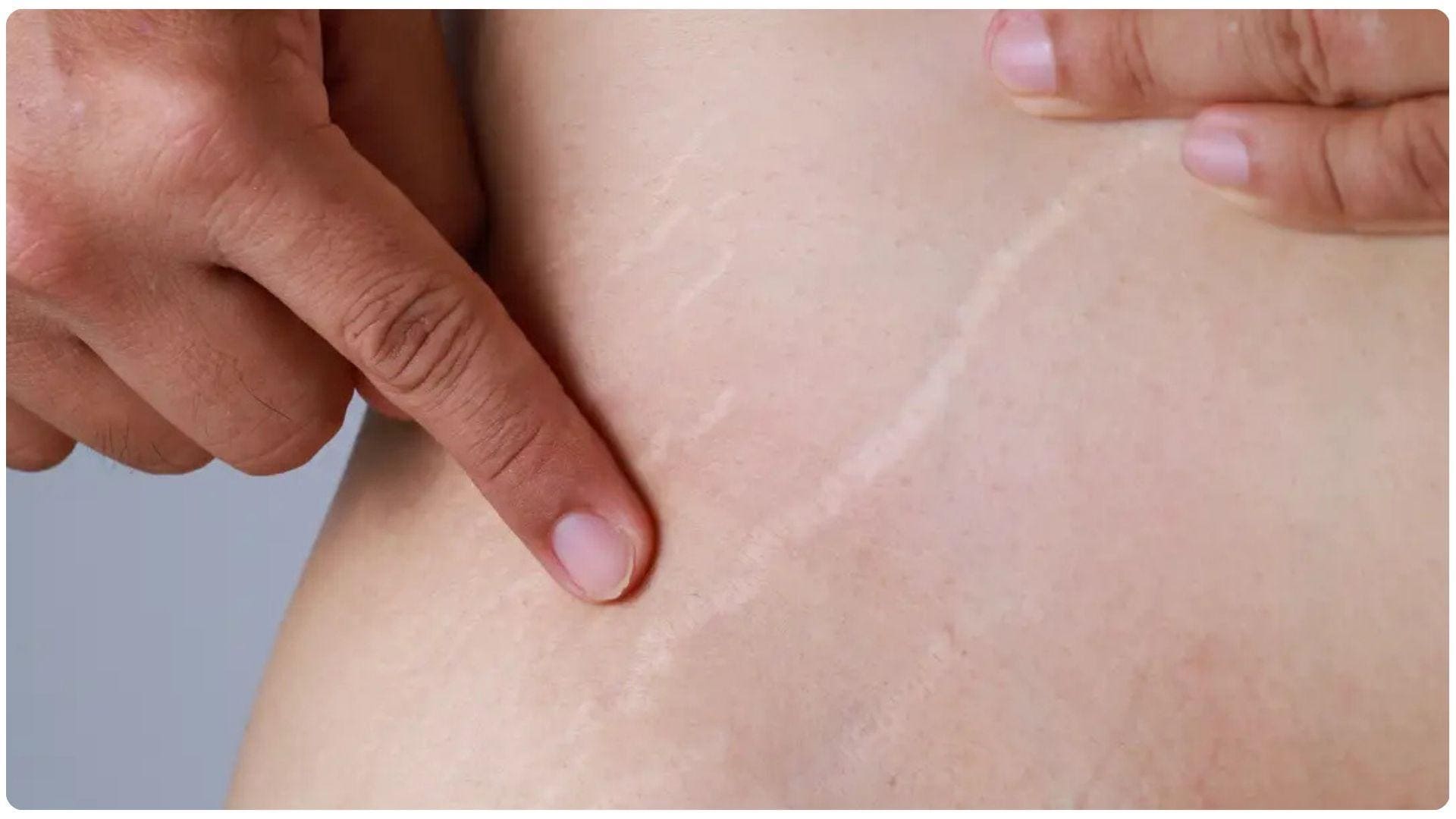 Vết rạn da đùi khiến làn da kém mịn màng