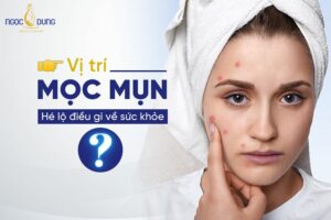 Vị trí mụn trên mặt nói lên điều gì về sức khỏe của bạn? Theo dõi ngay