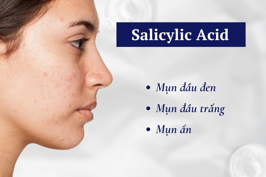 Salicylic Acid có công dụng hỗ trợ điều trị mụn