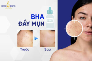 Dùng BHA đẩy mụn trong bao lâu? Phân biệt purging và break out