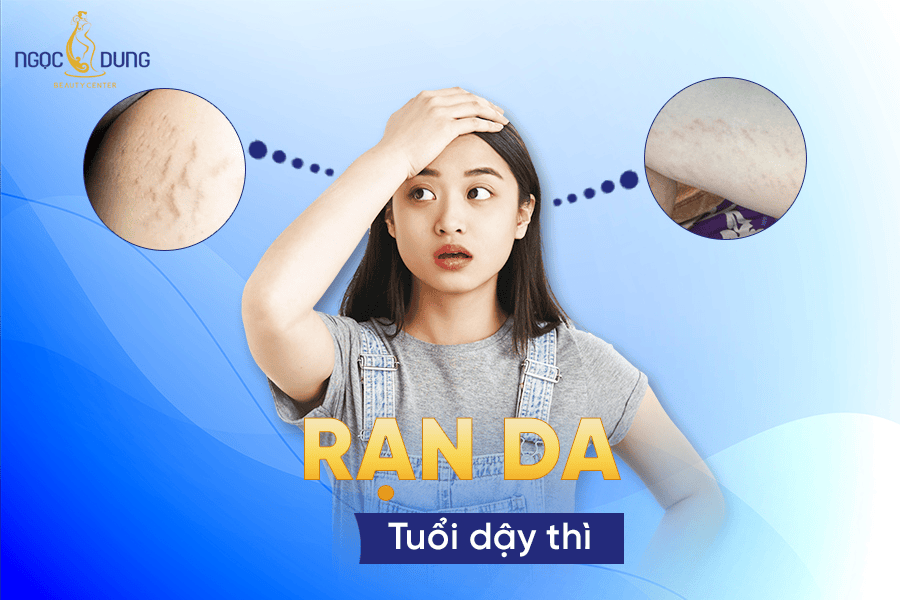 Cách trị vết rạn ở tuổi dậy thì hiệu quả cùng sự nhanh chóng
