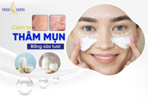 cach tri tham mun bang sua tuoi