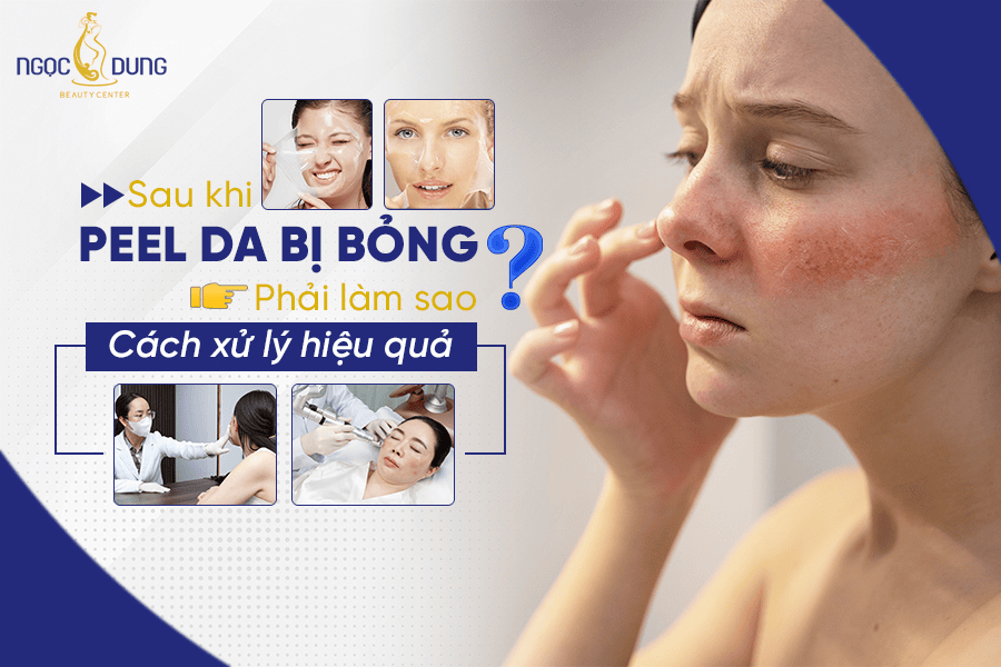 Cách xử lý khi peel da bị bỏng 