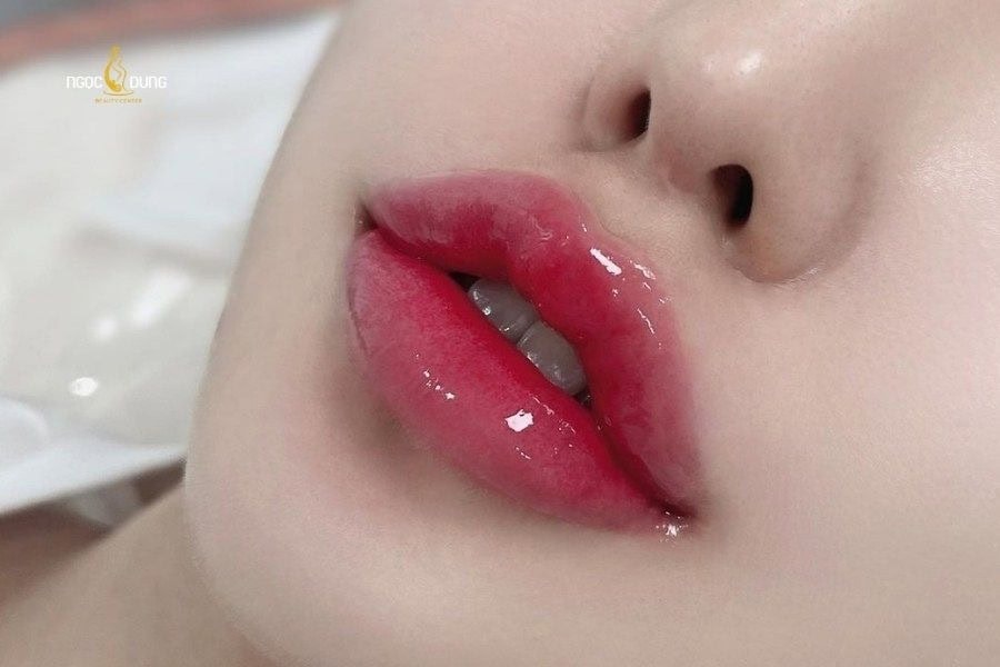 Cấy môi sinh học giúp môi căng bóng và hồng hào