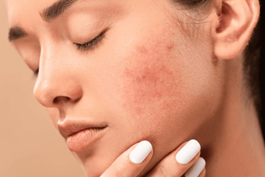 Có nhiều nguyên nhân dẫn đến mặt bị ngứa như dị ứng mỹ phẩm, stress,...