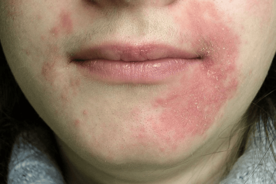 Da tổn thương thường có biểu hiện như mụn nước, nóng rát, sắc tố da thay đổi,...