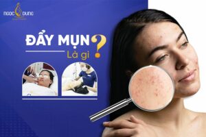 Đẩy mụn là gì? Quá trình đẩy mụn mất bao lâu? Giải đáp ngay cùng chuyên gia