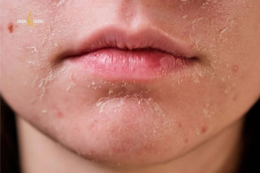 Da mặt bị ngứa sần sùi phải làm sao? Cách xử lý chuẩn 3 Bề mặt da thô ráp và bong tróc là biểu hiện chính của tình trạng bị ngứa da mặt sần sùi