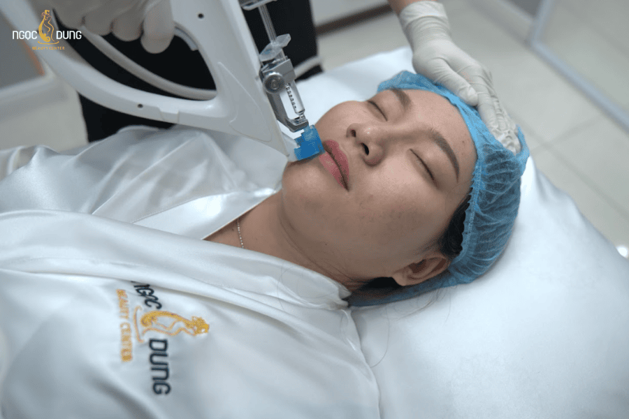 IPAC Laser kích thích collagen và elastin giúp môi căng bóng, mềm mịn