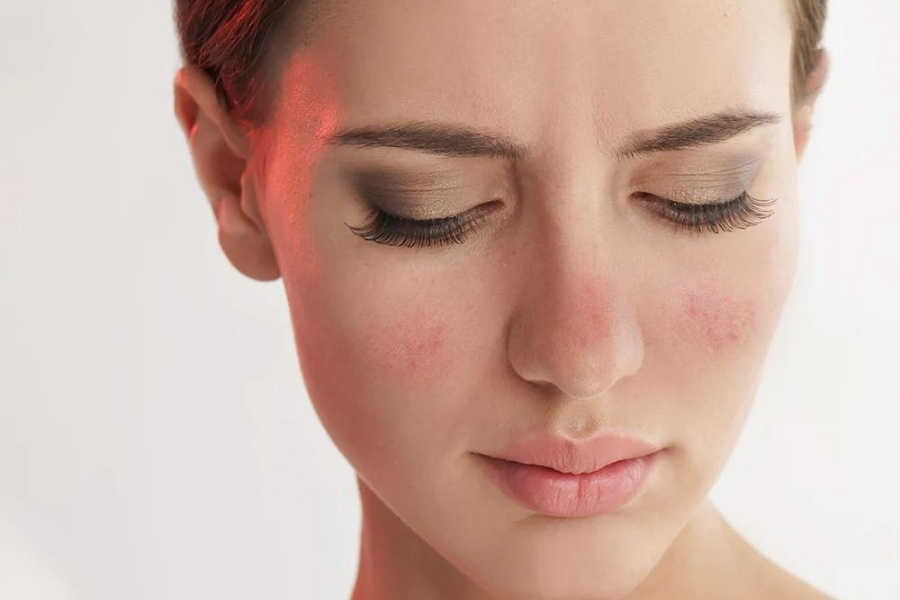 Khi sử dụng các sản phẩm chăm sóc da chứa steroid, da sẽ đẹp cấp tốc nhưng cũng sẽ tồi tệ hơn khi ngừng sử dụng