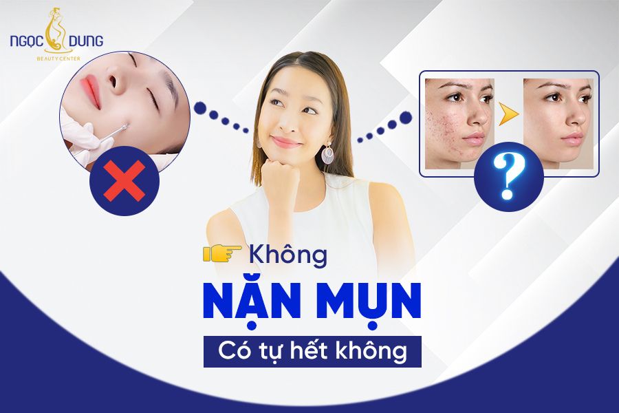 Không nặn mụn có tự hết không? Hãy giải đáp ngay cùng chuyên gia 